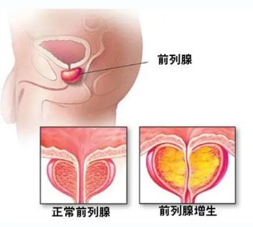注意！排尿困难、夜尿频繁，可能是前列腺增生(图1)